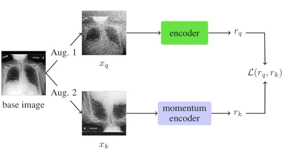 Covid-19 Triage: Computer vision for x-rays helps triage Covid-19 patients.