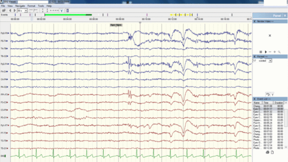 Unlabeled Brainwaves Spill Secrets: Deep learning helps doctors interpret EEGs.
