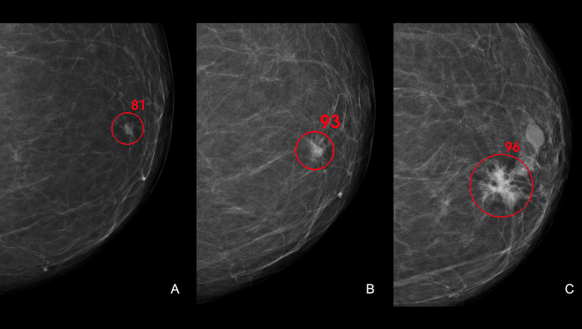 Rigorous Trial: AI matches humans in breast cancer diagnosis.